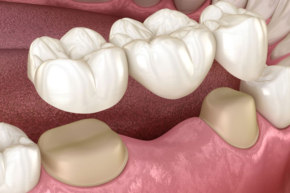 Dental bridge of 3 teeth over molar and premolar.