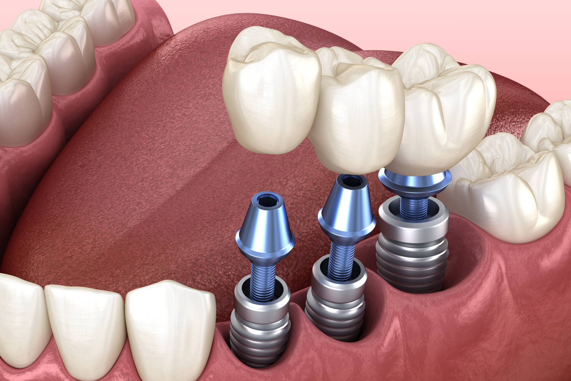 3 tooth crowns placement over 3 implants