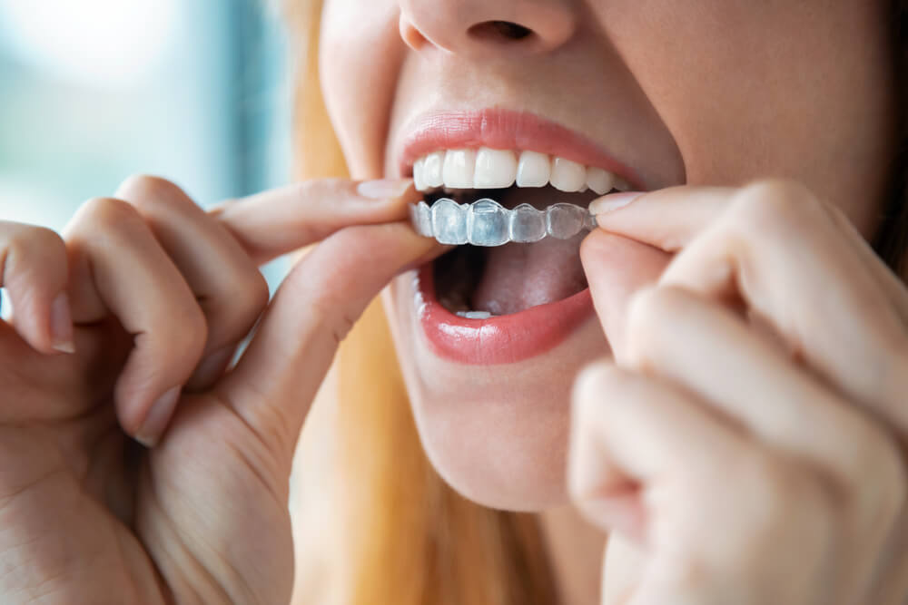 Close-up of woman wearing orthodontic silicone trainer.