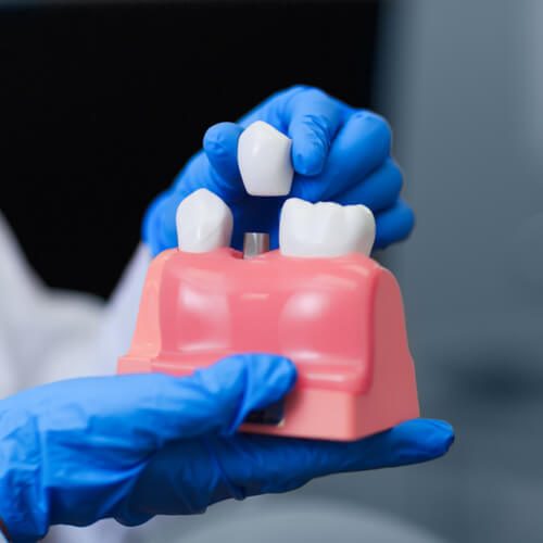 Real doctor holding model of teeth with dental implant,