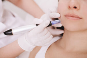 SkinPen Microneedling