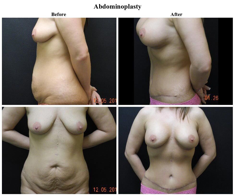 Before treatment and After Abdominoplasty treatment