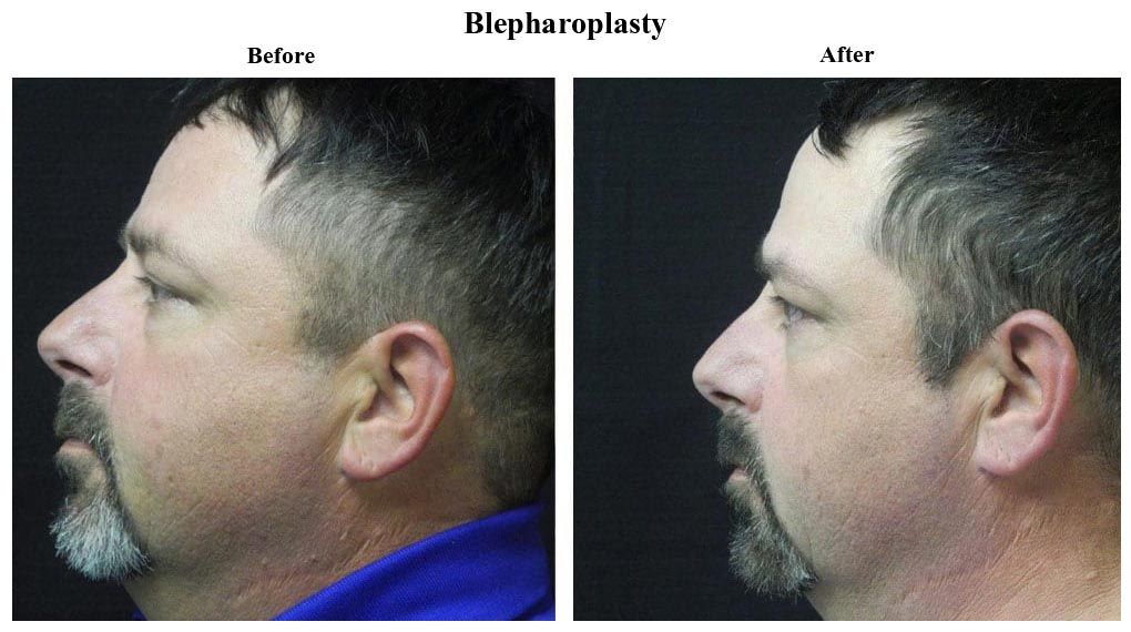 Before treatment and After Blepharoplasty treatment