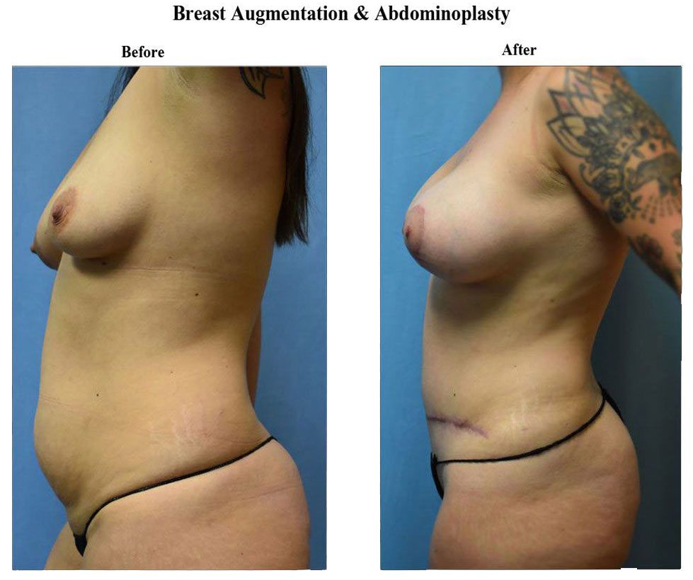 Before treatment and After Breast Augmentation Abdominoplasty treatment