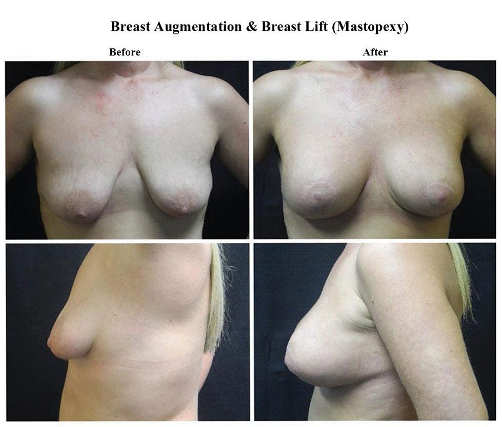 Before treatment and After Breast Lift treatment
