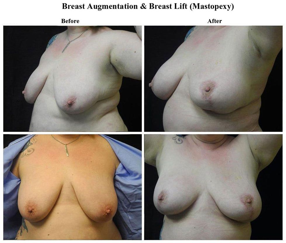 Before treatment and After Breast Lift treatment