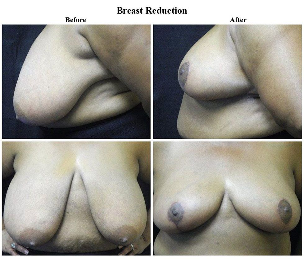 Before treatment and After Breast Reduction treatment