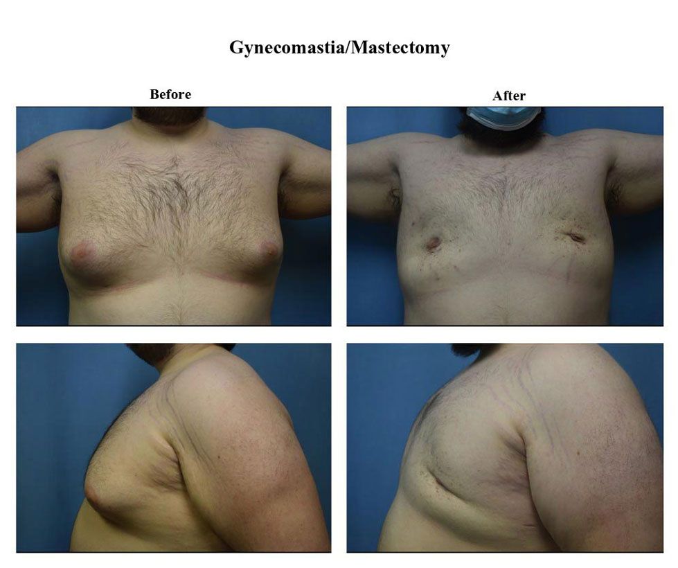 Before treatment and After Gynecomastia Mastectomy treatment
