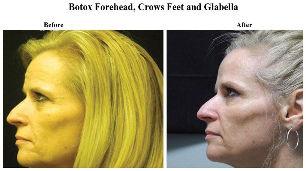 Before treatment and After Injectables – Botox treatment