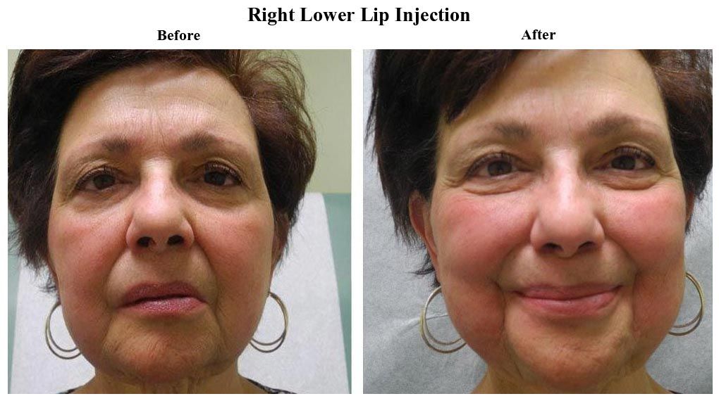 Before treatment and After Injectables – Restylane Silk treatment