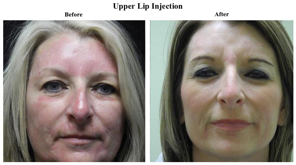 Before treatment and After Injectables – Restylane Silk treatment