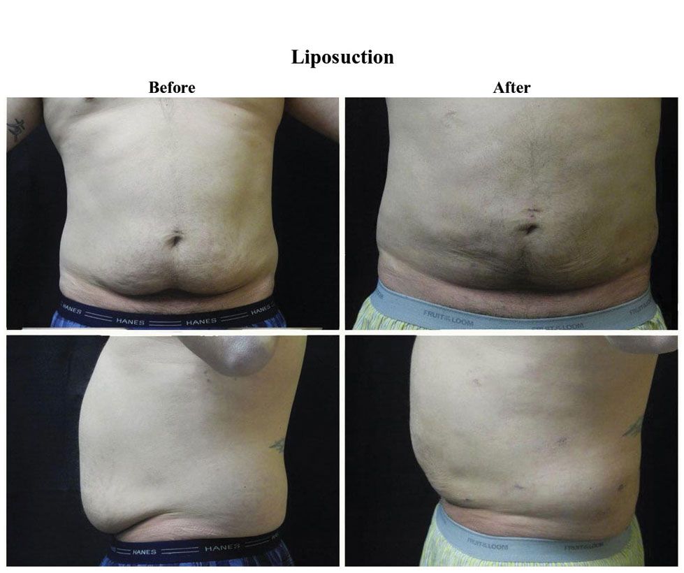 Before treatment and After Liposuction treatment