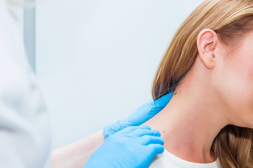 Doctor dermatologist examines birthmark of patient close up