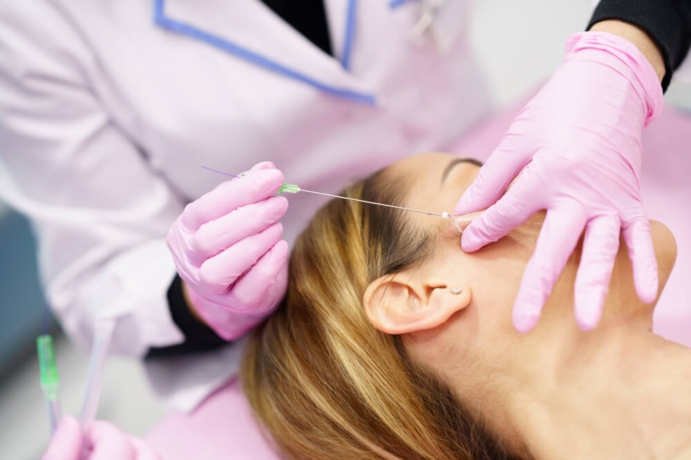 Doctor injecting PDO suture treatment threads into the face of a woman