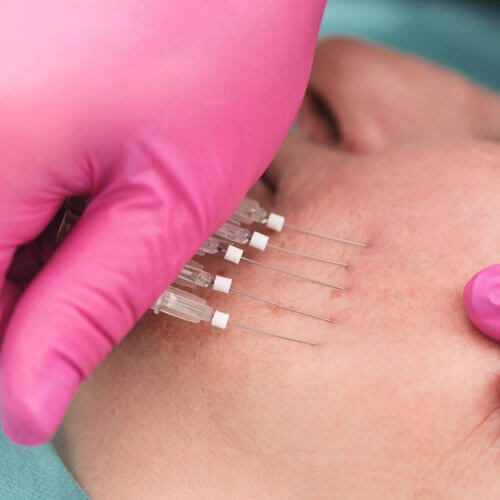 Woman having thread lift treatment