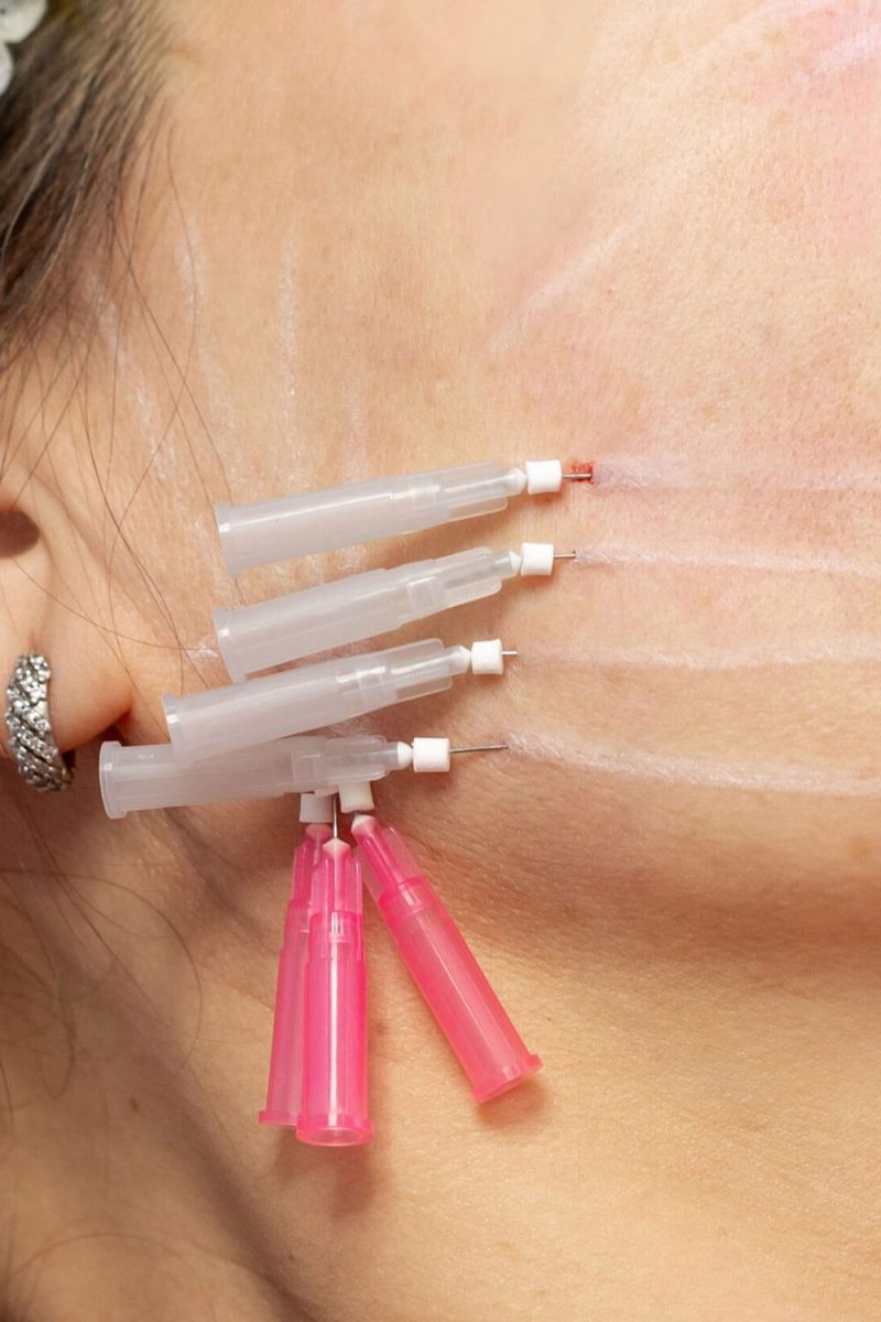 Woman having thread lift treatment