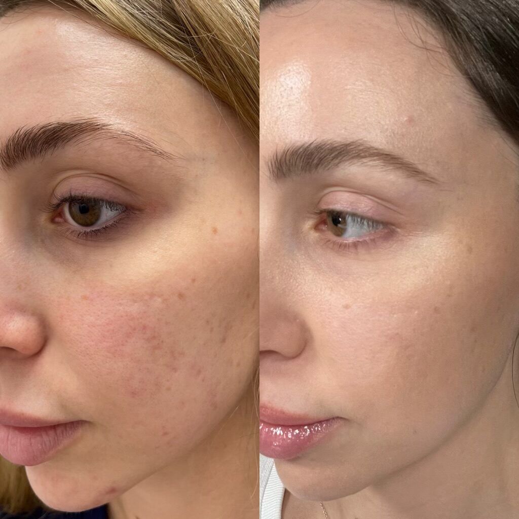 Before after treatment image
