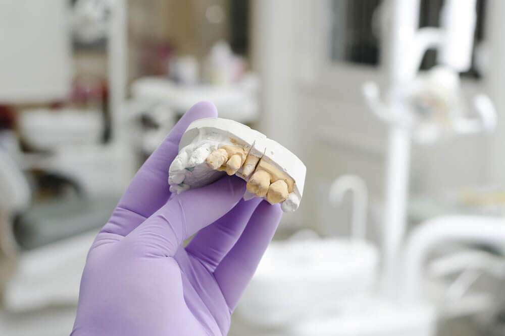 Hand of dentist holding dental gypsum models