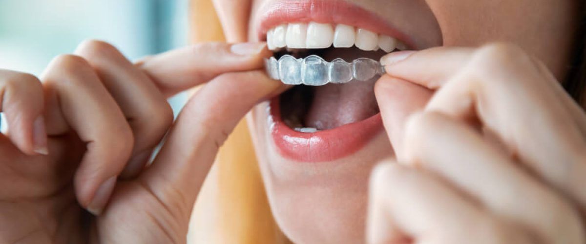 Close-up of woman wearing orthodontic silicone trainer.