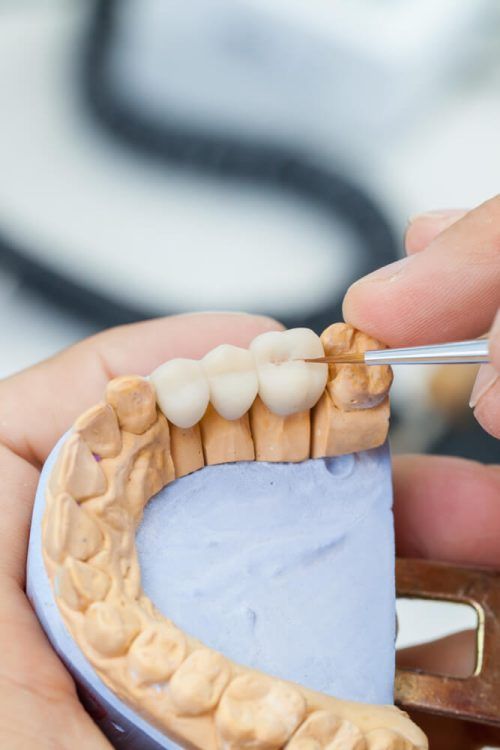 Technician dental is working with complete lower and upper metal ceramic