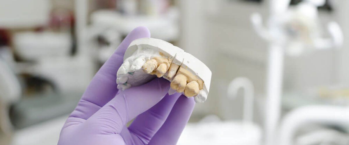 Hand of dentist holding dental gypsum models