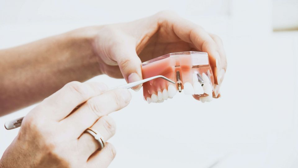 Dentist show model of dental implant