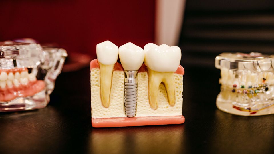 Educational model of gum with dental implant
