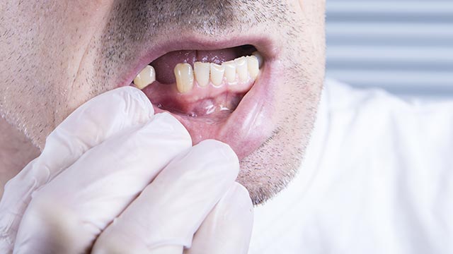 Closeup teeth, dental health care clinic with missing tooth