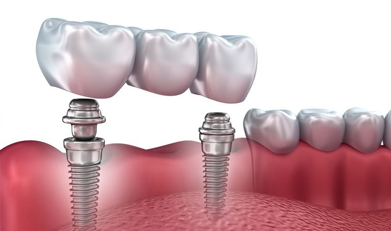 Dental Implants in line