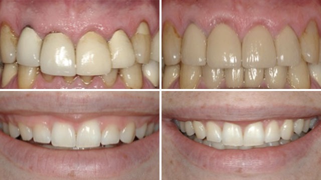 Teeth indirect restoration Before and After