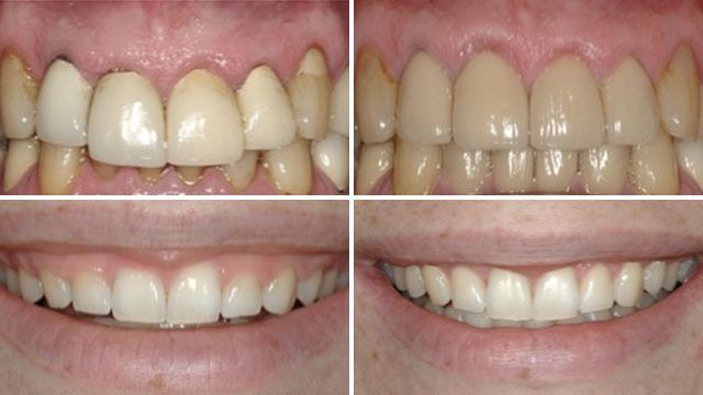 Teeth indirect restoration Before and After