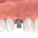 Tooth implant instalation process