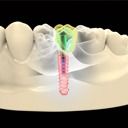 3D rendering tooth implant