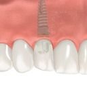 dental-implant-3 teeth