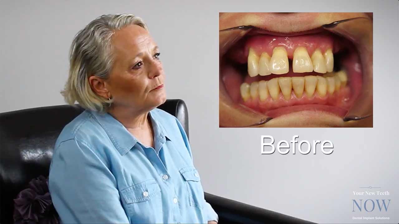 dental implants changed my life kathys story