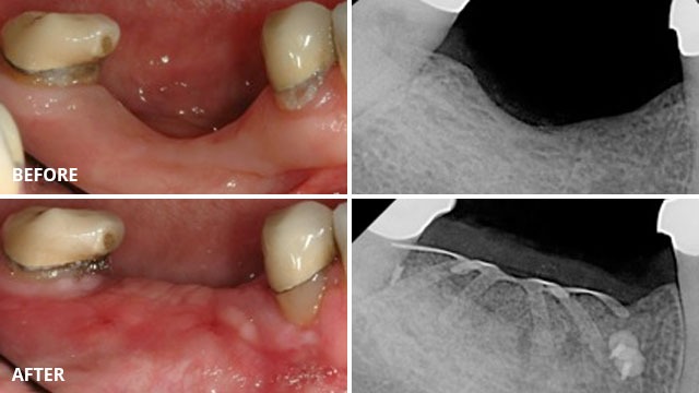 guided-bone-regeneration