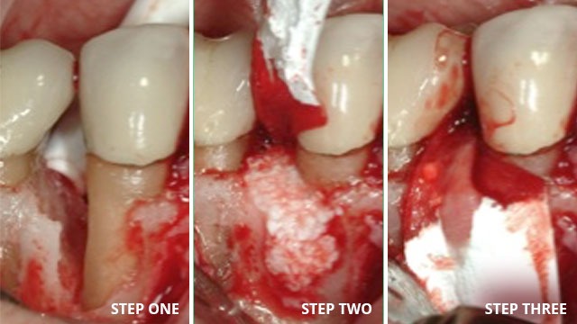 guided-tissue-regeneration