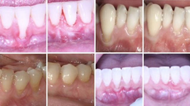 Teeth calculus and tartar cleaning Before and After