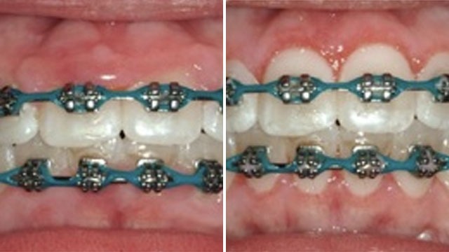 braces position on upper and lower teeth