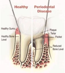 image tooth caries disease
