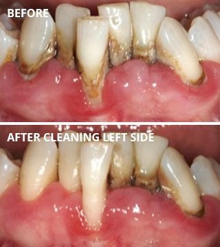 Before and after dental treatment