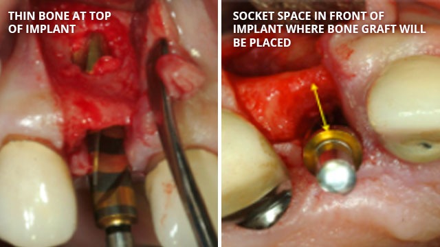 nailed flap of soft tissue with a pin in the gum