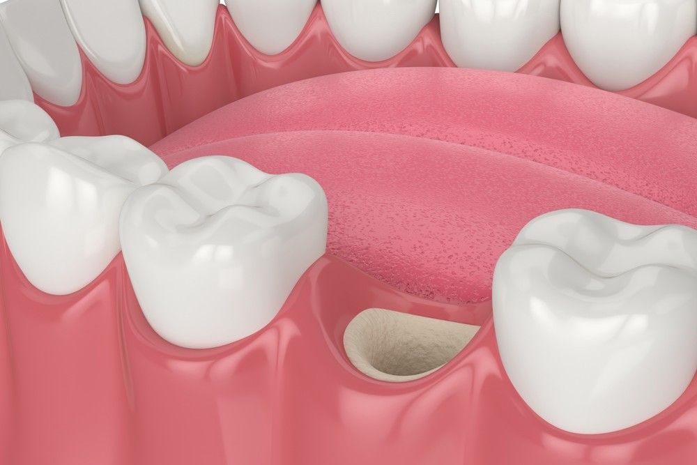 3D render of jaw with empty socket ready to bone grafting