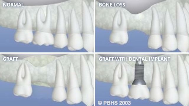 Bone Grafting before and after