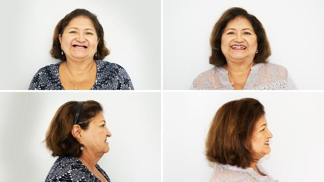 The life changing benefits of dental implants before and after
