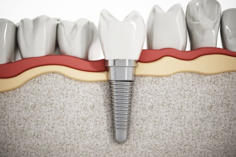 teeth showing dental implant structure