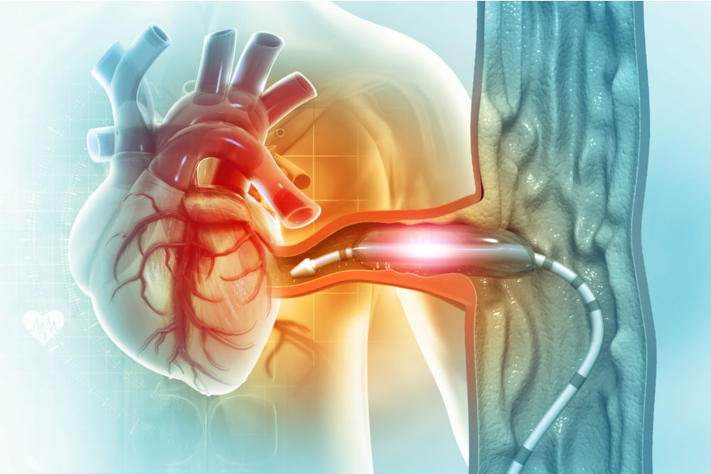 Cardiac catheterization procedure. Stent angioplasty. 3d illustration