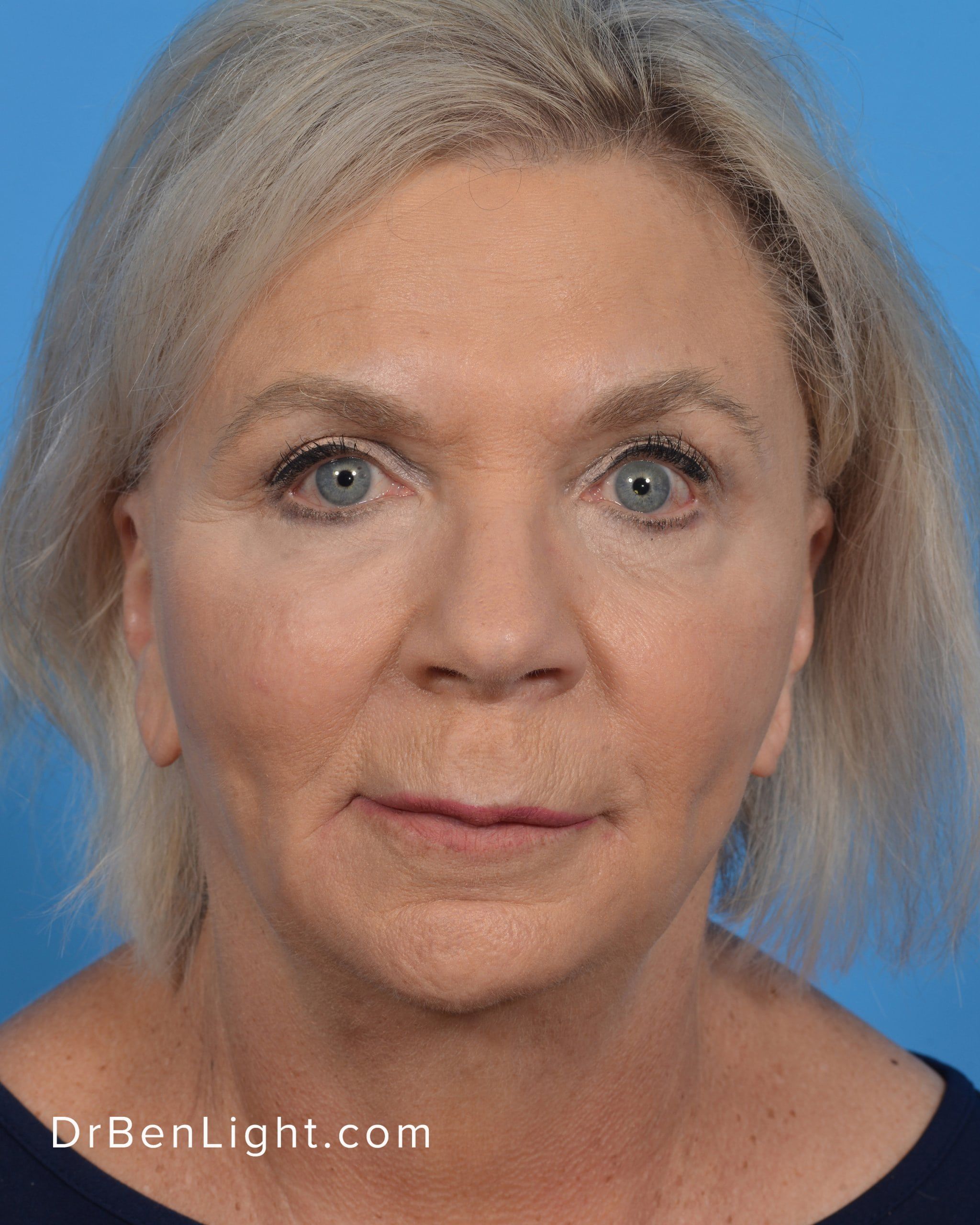 BodyTite FaceTite Accutite Archives Dr. Ben Light