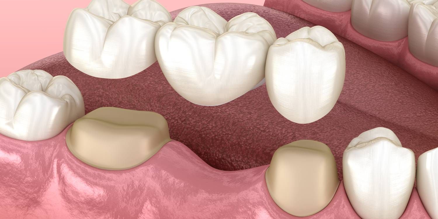 Dental bridge of 3 teeth over molar and premolar