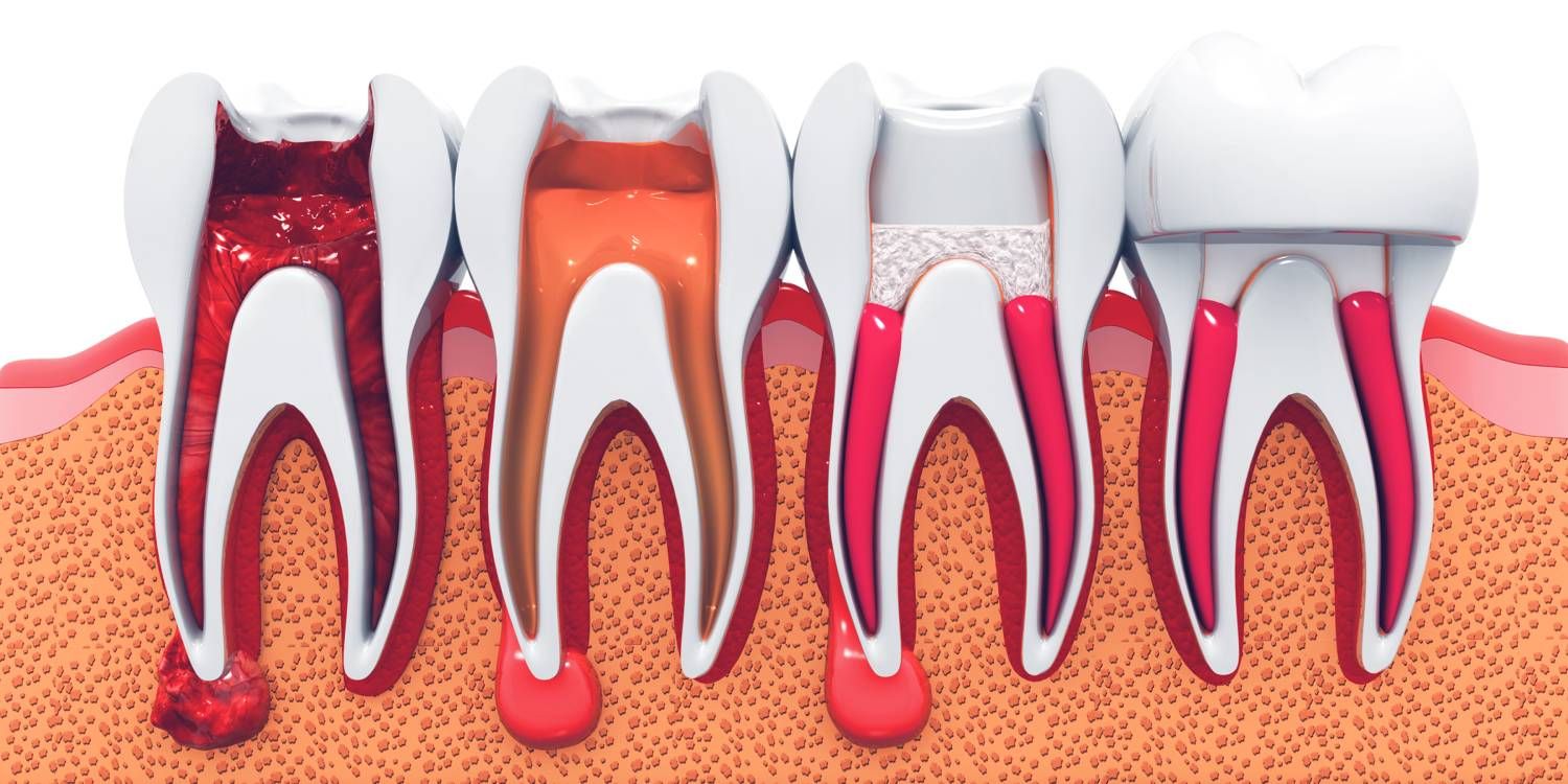 stages of root canal treatment